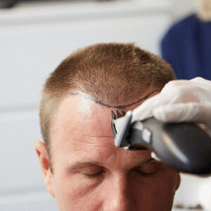 Comprehensive Guide to Hair Transplantation