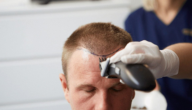 Comprehensive Guide to Hair Transplantation