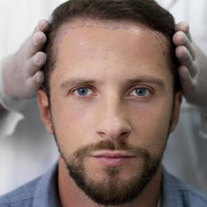 What Happens After a Hair Transplant?