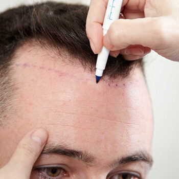 10 Commonly Asked Questions About Hair Transplantation