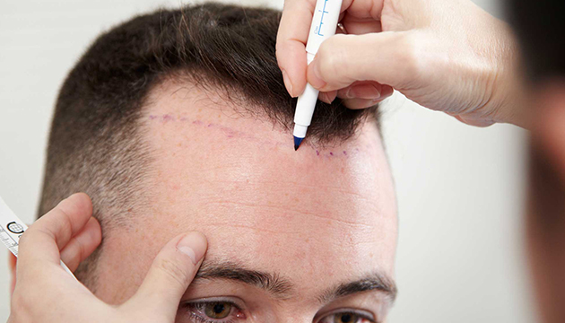 10 Commonly Asked Questions About Hair Transplantation